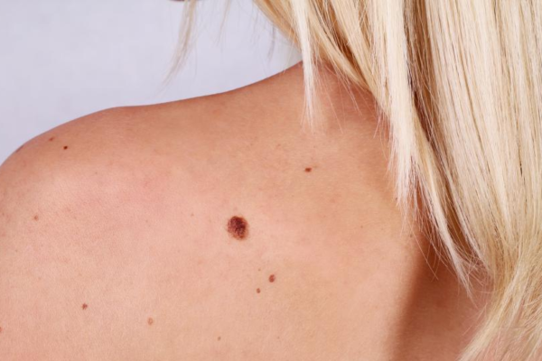 How To Use Castor Oil To Remove Moles