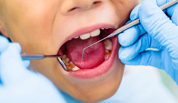 7 ways to get rid of Cavities 7 ways to get rid of Cavities