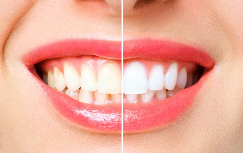 How to make your Teeth "SNOW WHITE"