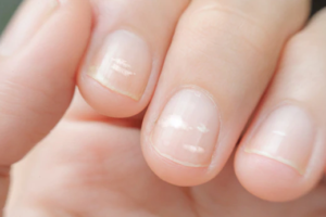 White Spots On Fingernails – Causes And Treatment